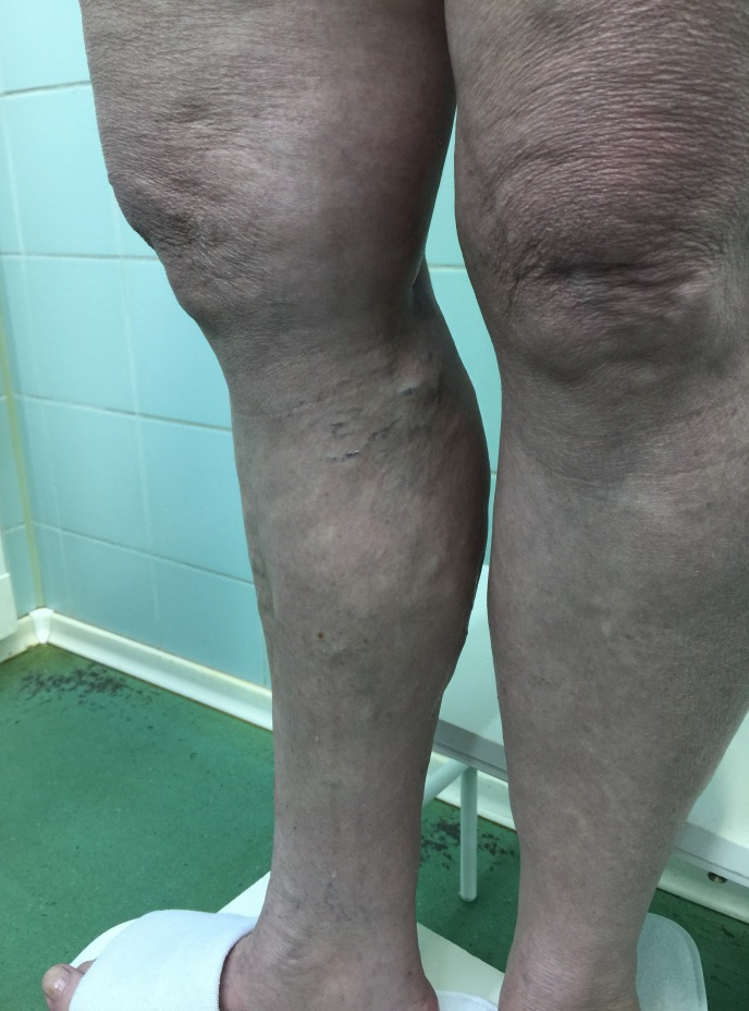Коричневые пятна на коже ног: причины и лечение